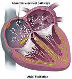 [city] atrial fibrillation